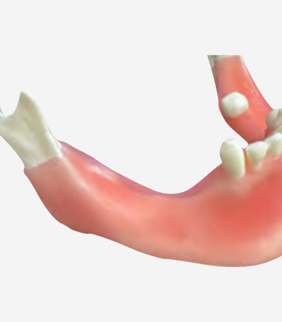 BONE AUGMENTATION - REGENERATION - BA 10