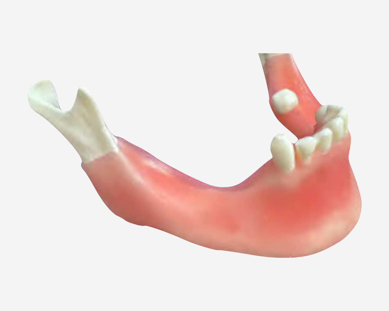 BONE AUGMENTATION - REGENERATION - BA 10 BONE AUGMENTATION - REGENERATION - BA 10