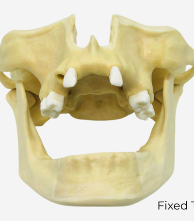 SINUS LIFT MODELS - DM 132-2