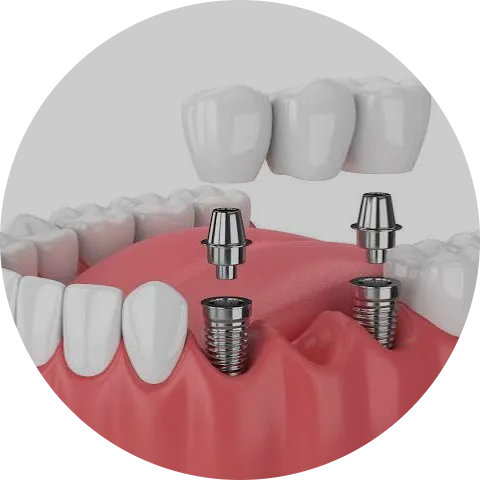 Dental Impants